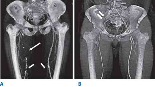 Arterial Disease Basicmedical Key
