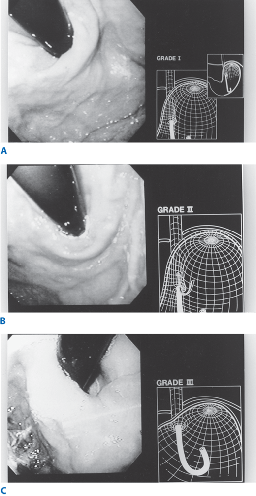 Esophagus and Diaphragmatic Hernia Basicmedical Key