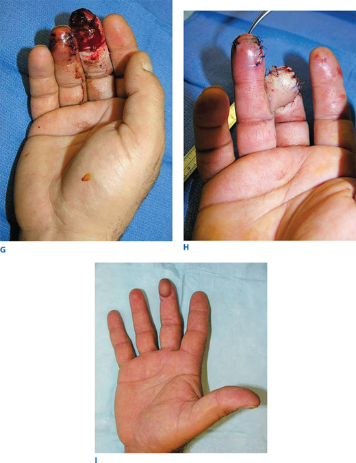 Surgery of the Hand and Wrist Basicmedical Key