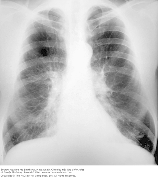 Chest X Ray Copd