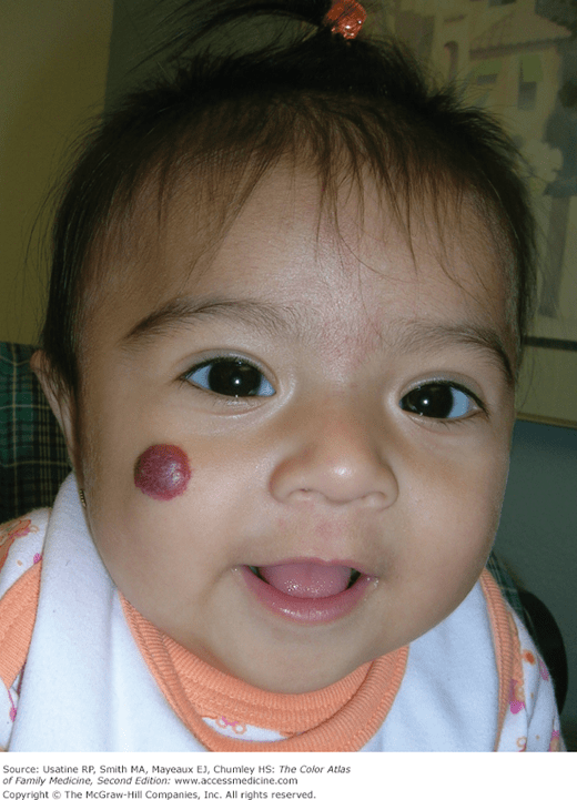 Childhood Hemangiomas and Vascular Malformations Basicmedical Key