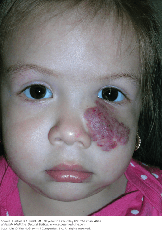 Cavernous Hemangioma