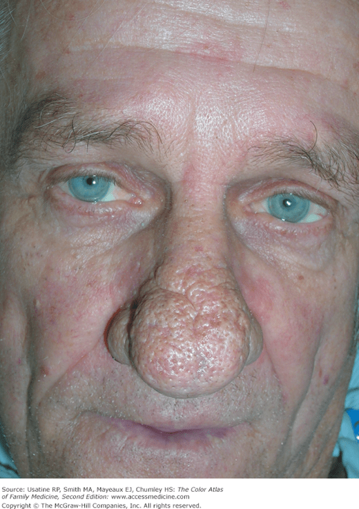 Rosacea Basicmedical Key