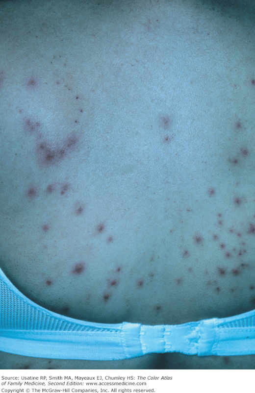 Folliculitis Basicmedical Key