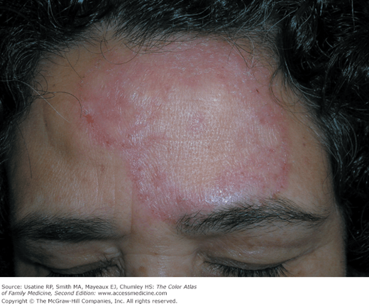 Fungal Overview | Basicmedical Key