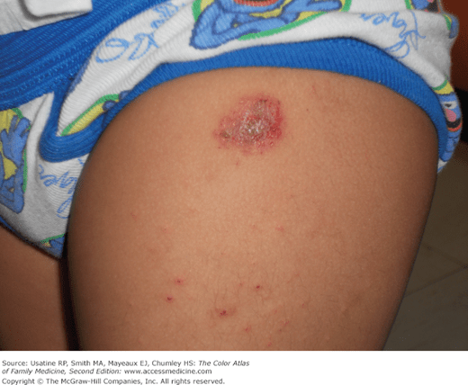 Nummular Eczema | Basicmedical Key