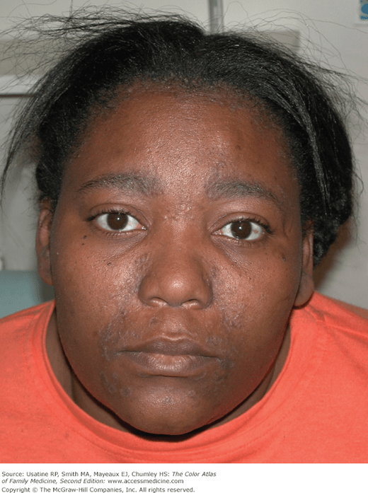 Eczema Rash On Black Skin