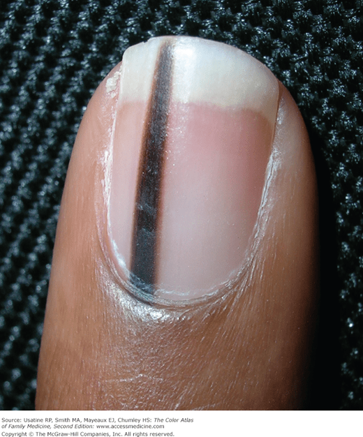Pigmented Nail Disorders Basicmedical Key
