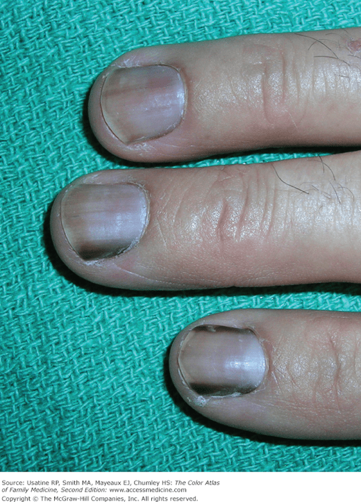 Hutchinson Sign Nail Melanoma Nail Ftempo