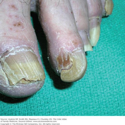 Onychomycosis Basicmedical Key