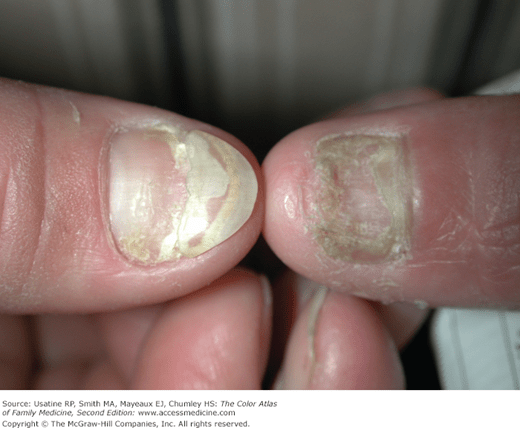 Onychomycosis Basicmedical Key