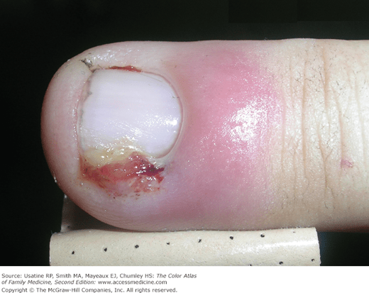 Paronychia Basicmedical Key