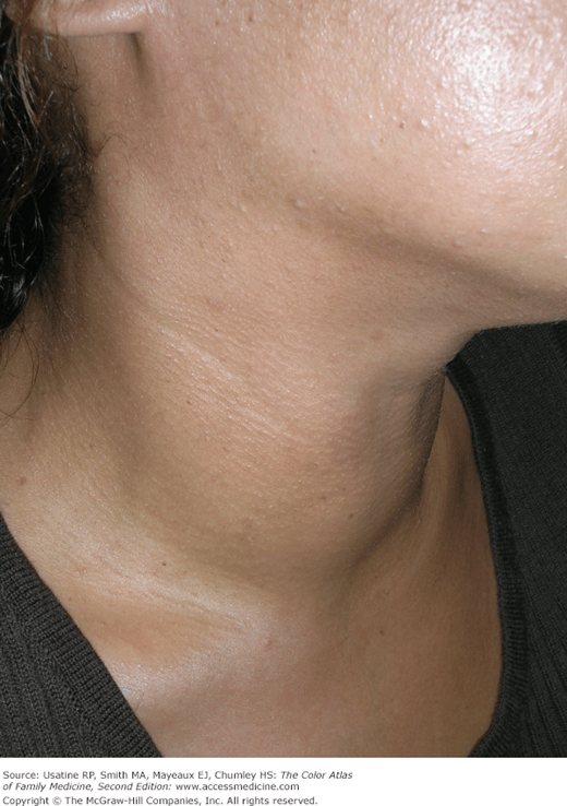 Graves’ Disease and Goiter Basicmedical Key