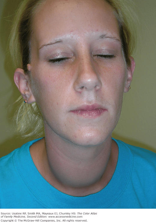 Graves’ Disease and Goiter Basicmedical Key