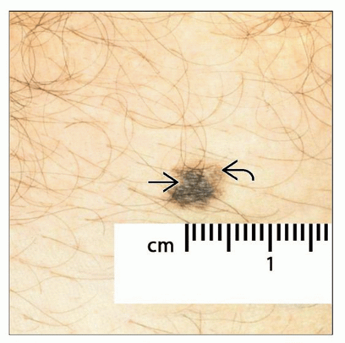 Atypical (Dysplastic) Melanocytic Nevi Basicmedical Key