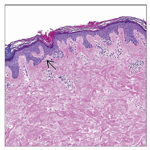 Atypical (Dysplastic) Melanocytic Nevi Basicmedical Key
