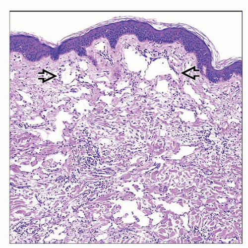 Atypical Vascular Lesion Basicmedical Key