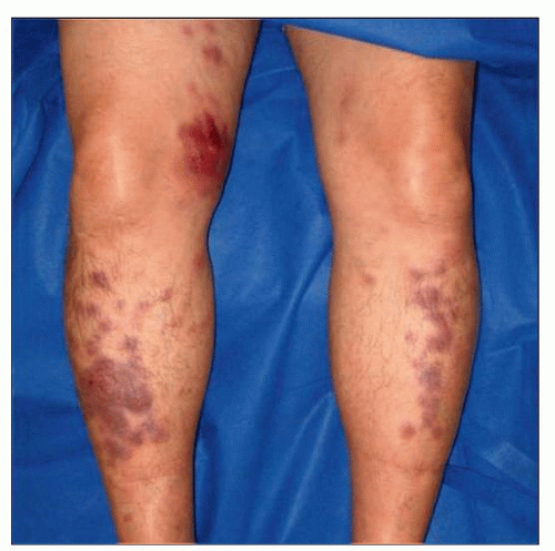 Blastic Plasmacytoid Dendritic Cell Neoplasm Basicmedical Key