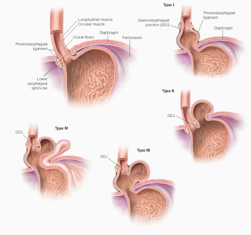 Transthoracic Hiatal Hernia Repair Basicmedical Key
