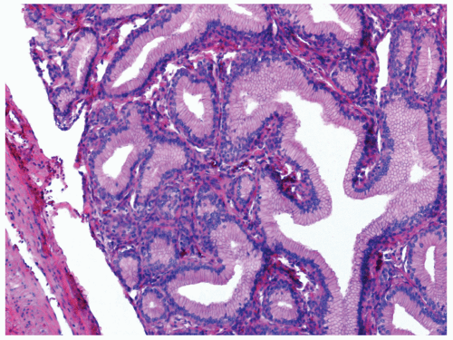 Seromucinous-Gland Neoplasms | Basicmedical Key