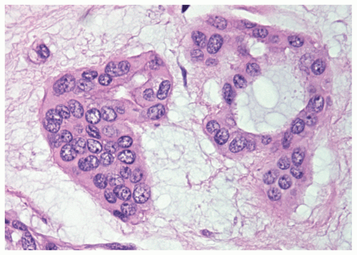 Seromucinous-Gland Neoplasms | Basicmedical Key