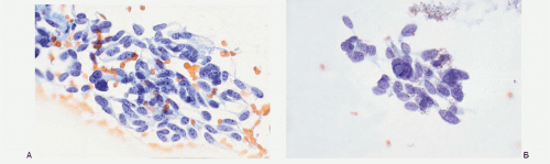 Pulmonary Neuroendocrine Tumors Basicmedical Key