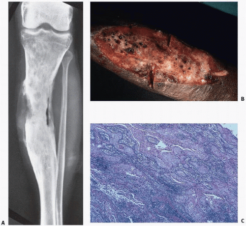 Osteomyelitis and Septic Arthritis | Basicmedical Key