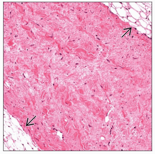 Nuchaltype Fibroma Basicmedical Key