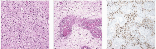Nuchal and Gardner Fibroma Basicmedical Key