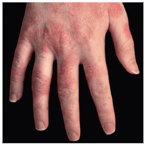 Irritant Contact Dermatitis Hand