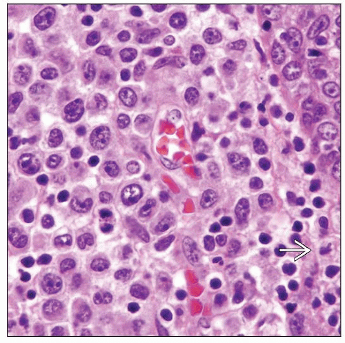 Primary Cutaneous Anaplastic Large Cell Lymphoma Basicmedical Key