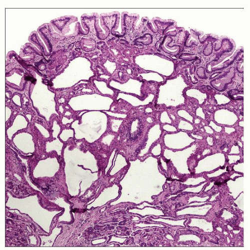 Fundic Gland Polyp Basicmedical Key