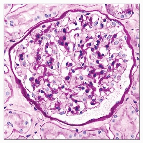 Thin Basement Membrane Disease Basicmedical Key