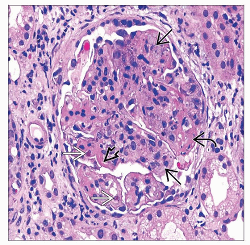Systemic Lupus Erythematosus Basicmedical Key