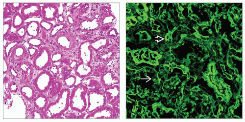 Monoclonal Immunoglobulin Deposition Disease Basicmedical Key