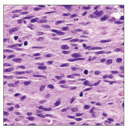 Mycobacterial Spindle Cell Pseudotumor Basicmedical Key