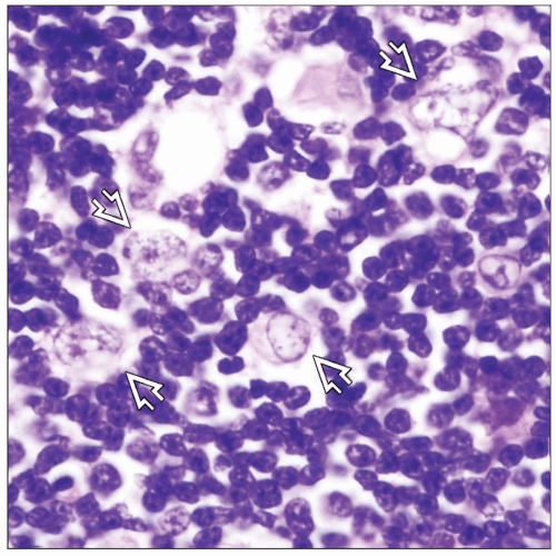 Overview of Malignant Thymic Neoplasms Basicmedical Key