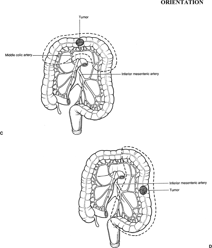 Right and Left Colon Resections Basicmedical Key