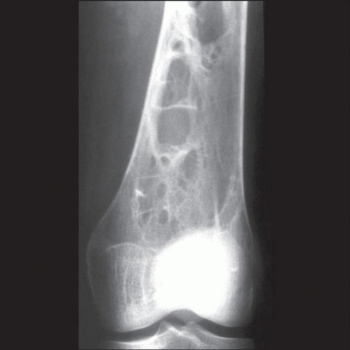 Gaucher Disease Basicmedical Key