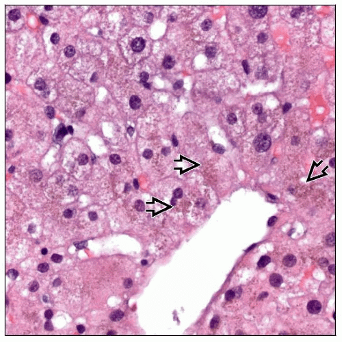Gilbert Disease Basicmedical Key
