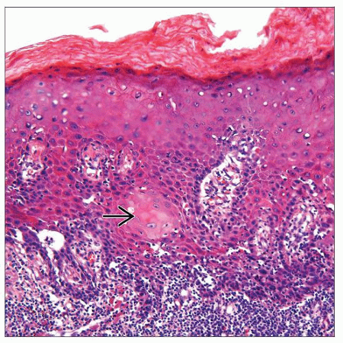 Penile Intraepithelial Neoplasia (PeIN) Basicmedical Key