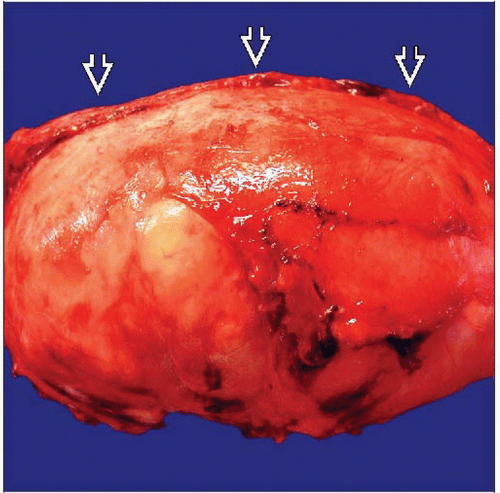 Schwannoma Basicmedical Key