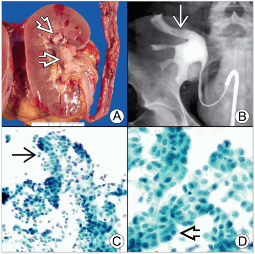 Urothelial Carcinoma Basicmedical Key