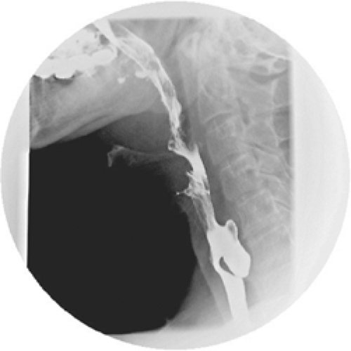 Pathology and Treatment of Zenker Diverticulum Basicmedical Key