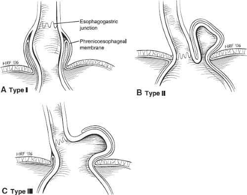Open Paraesophageal Hernia Repair Basicmedical Key