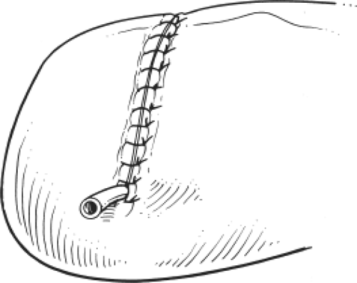 Transmetatarsal and Ray Amputations | Basicmedical Key