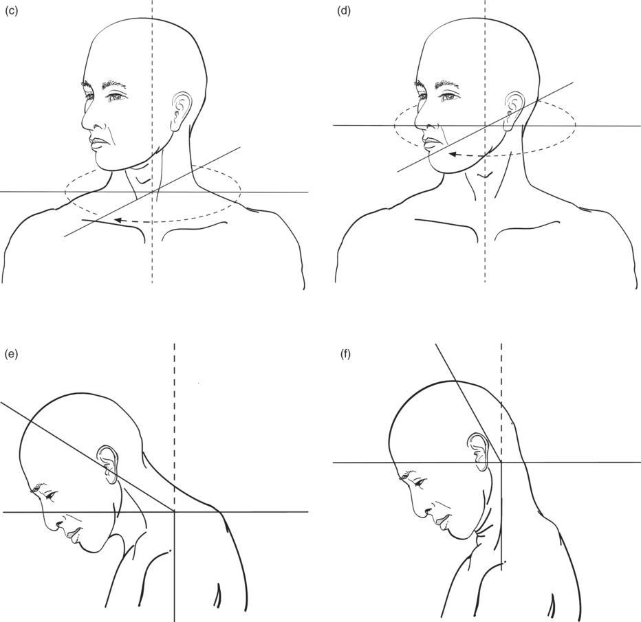 Examination and treatment of complex cervical dystonia Basicmedical Key