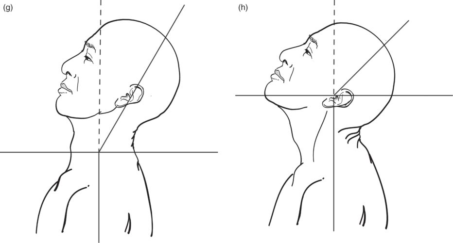Examination and treatment of complex cervical dystonia Basicmedical Key