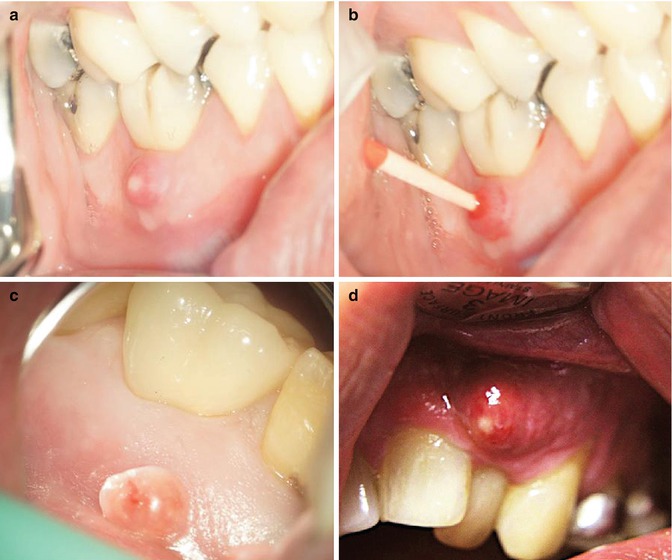Endodontic Emergencies Basicmedical Key