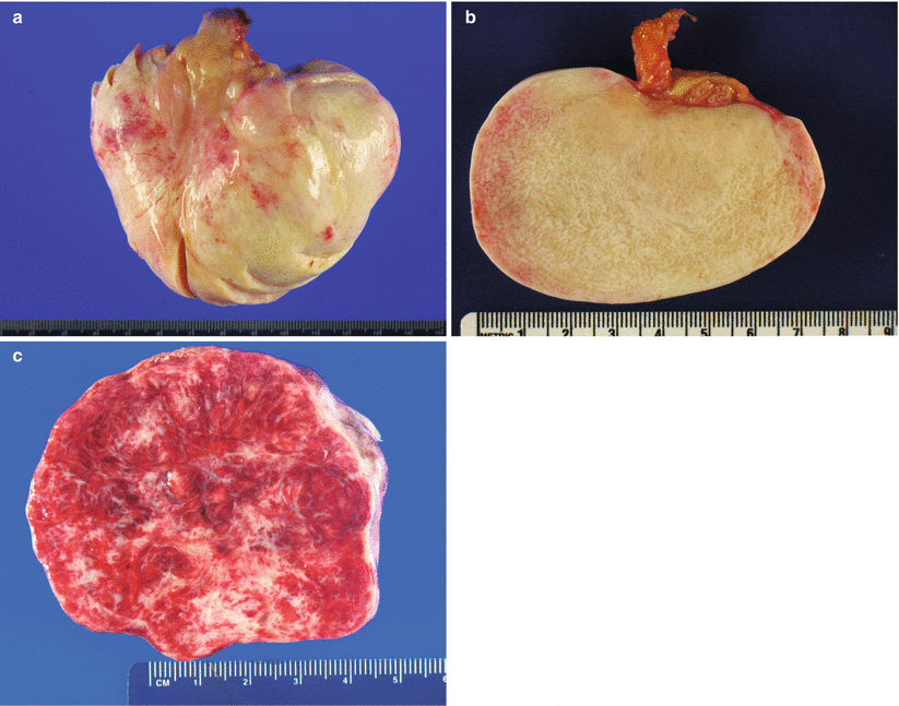 Ovarian Sex CordStromal Tumors Basicmedical Key